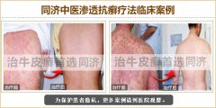 长春肤康医院治疗牛皮癣患者症状图