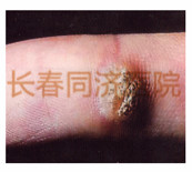 寻常疣症状图