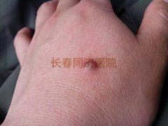 寻常疣症状图