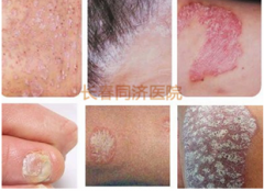 长春肤康医院详谈牛皮癣的症状表现