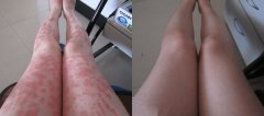 长春皮肤病医院介绍牛皮癣的症状