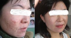青春痘的康复