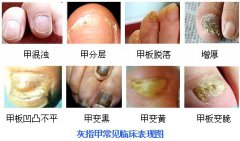 灰指甲的各类症状表现