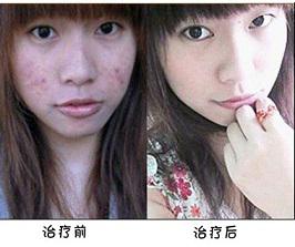 长春皮肤病医院医生介绍青春痘