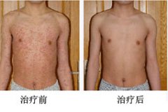 长春皮肤病医院治疗荨麻疹患者