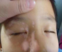白癜风的症状