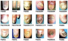 长春肤康医院介绍灰指甲种类