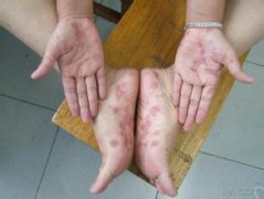 手足癣症状