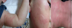 荨麻疹症状,治疗,病因