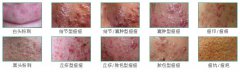 长春肤康医生介绍青春痘症状