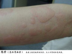 荨麻疹症状