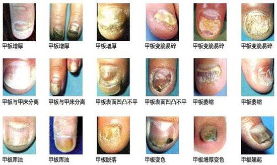 灰指甲症状