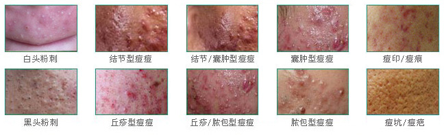 青春痘几大症状