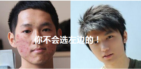 青春痘治疗前后对比