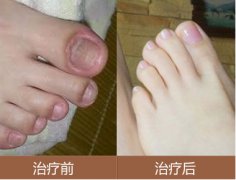 长春治疗灰指甲医院