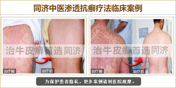 长春肤康医院介绍牛皮癣