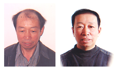 长春肤康医院治疗脱发
