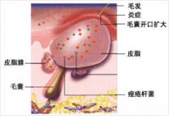 青春痘的治疗