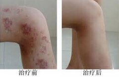 皮炎治疗前后对比图