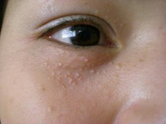 扁平疣症状表现