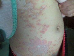 牛皮癣的症状