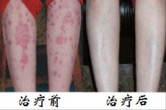 长春肤康治疗牛皮癣前后对比
