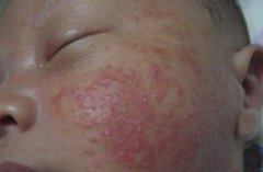 儿童湿疹的症状表现