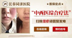 长春治疗湿疹哪家好