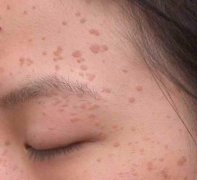 扁平疣的表现症状