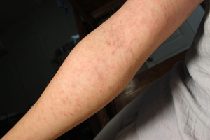 什么原因导致了湿疹后的皮肤变粗糙
