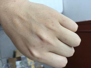 皮肤划痕症是什么?划痕症应该怎么治疗?