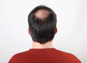 长春男性脱发能不能治好