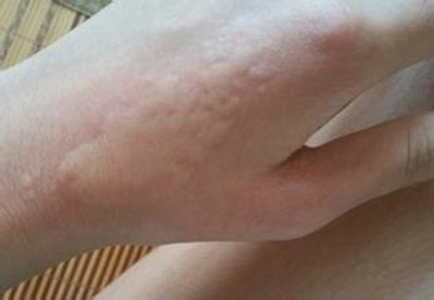如何预防春末夏初的皮肤疾病