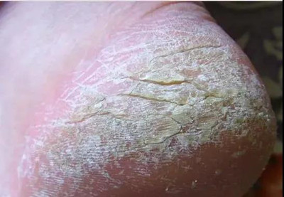 夏季常见的五种皮肤病有哪些?怎么预防