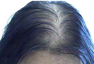 什么是溢脂性脱发