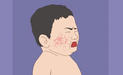 面部脂溢性皮炎怎么治不复发