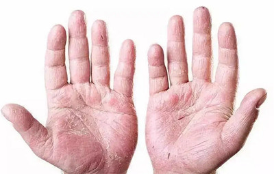 夏季手指脱皮到底是怎么回事？为什么总是脱皮？