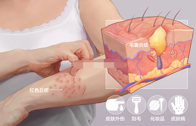长春毛囊炎怎么治疗好