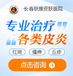 长春皮肤专科医院,丘疹性皮炎如何治疗